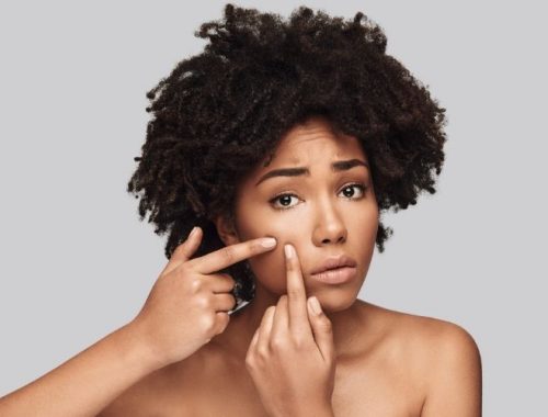 Cómo influye la dieta en el acné